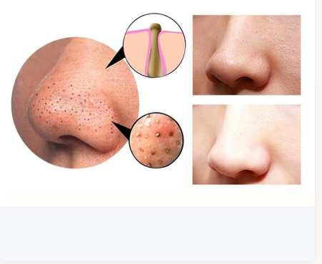 Blackhead Remover Machine Facial Pore Deep Cleansing